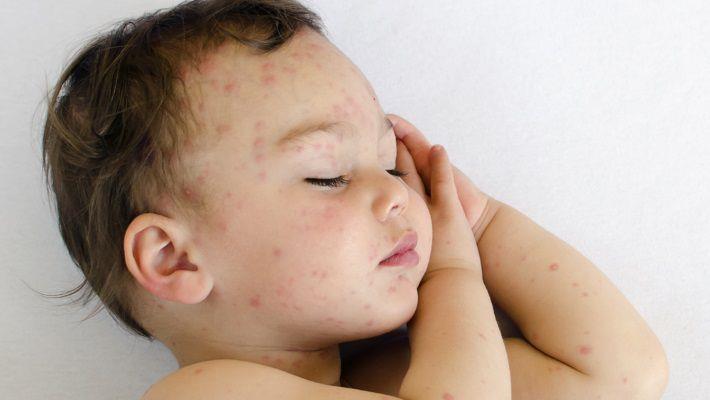 פריחת חום בעור אצל תינוק או ילד קטן