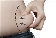ניתוח שאיבת שומן - להסיר את השומן במקומות שפעילות גופנית לא עוזרת