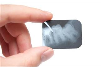 לטפל בשיניים בזמן טיפול בסרטן