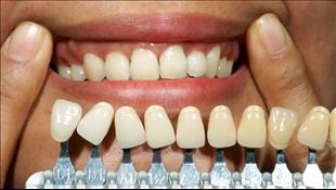שיניים ישרות ולבנות בשני טיפולים בלבד: הכל על ציפוי חרסינה