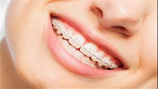 יישור שיניים שקוף או פנימי: כל השיטות - והיתרונות