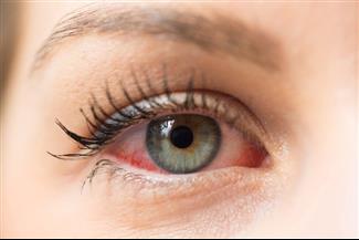 יובש בעיניים: מהם הטיפולים שישימו סוף לתופעה המטרידה?