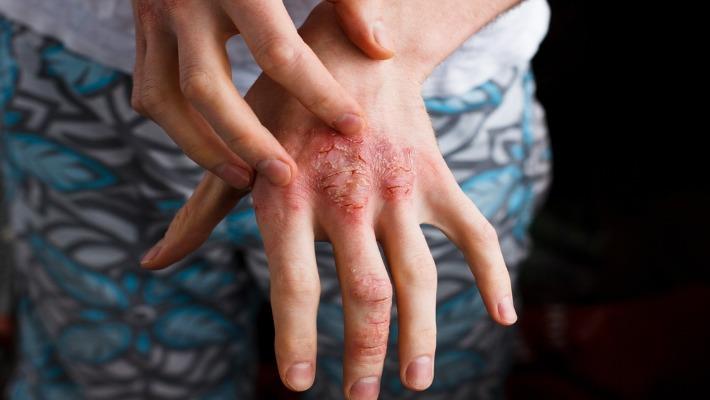 אישה מגרדת את ידה בעקבות פריחה שמקורה באטופיק דרמטיטיס