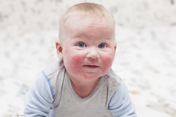 תינוק עם פריחה על פניו שהתפתחה בגלל אטופיק דרמטיטיס (אסתמה של העור)