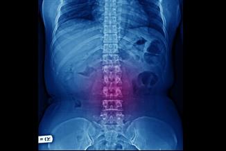 היצרות תעלת עמוד השדרה: הסוגים, הסימנים שיעלו חשד והטיפול