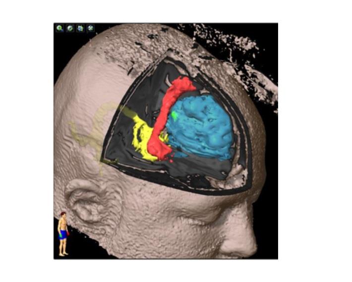 הדמייה מוחית של בדיקה חשמלית לפני כריתת גידול מוחי במסגרת ניתוח מוח בערות 