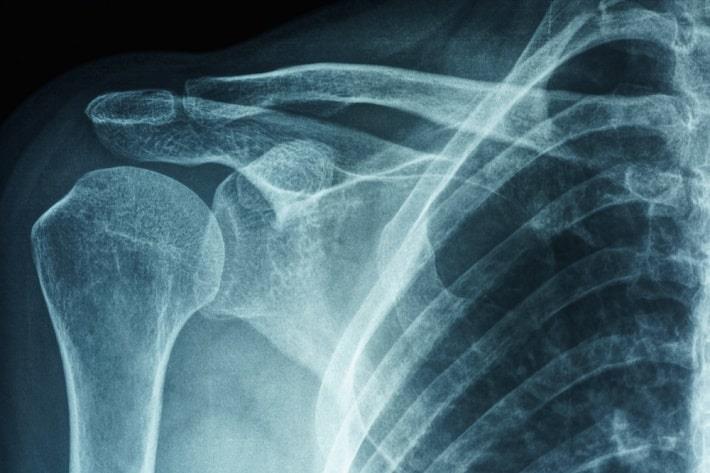 צילום רנטגן של פלג הגוף העליון לצורך אבחון כתף קפואה