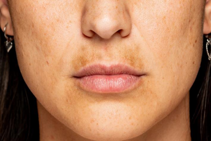 אישה סובלת ממלזמה (פיגמנטציה באזור השפם)
