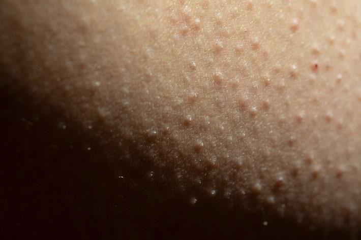הגדלה של קטע עור עם קרטוזיס פילאריס 