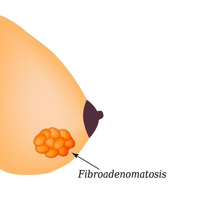 איור של שד עם פיברואדנומה