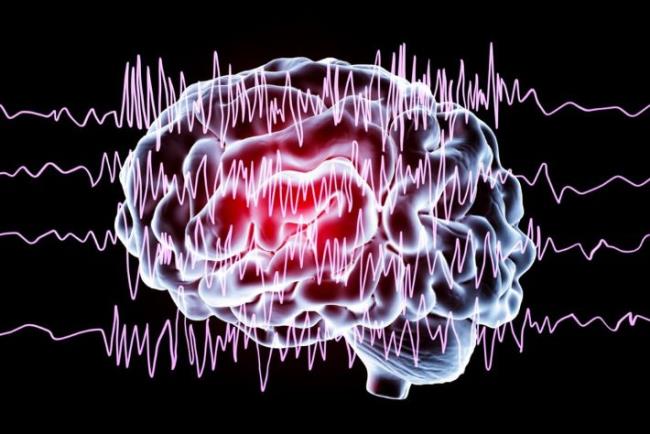 הדמיה של התקף אפילספיה בבדיקת EEG, ויגבטרין 