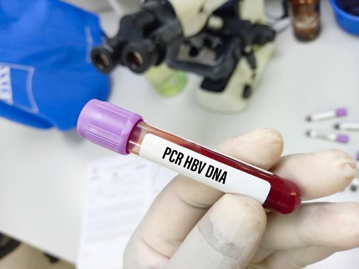 יד אוחזת במבחנת דם של בדיקת החומר הגנטי בדם של הפטיטיס B  