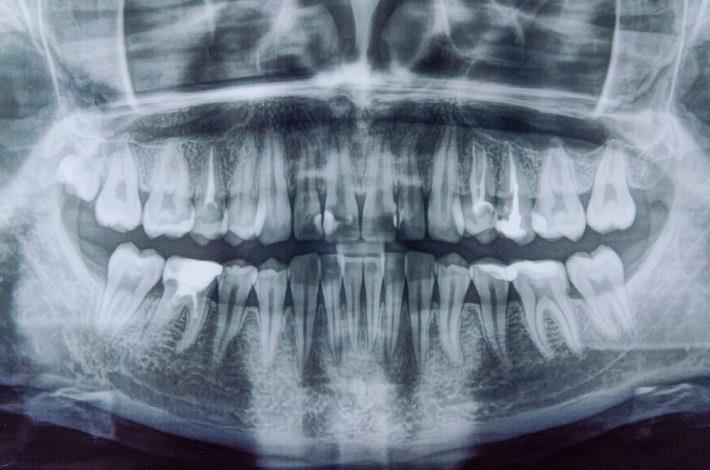 צילום פנורמי של שיניים קדמיות של אדם