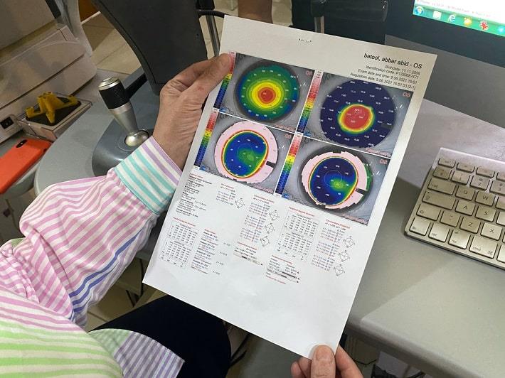 רופאת עיניים מחזיקה מפה טופוגרפית של מיפוי קרנית