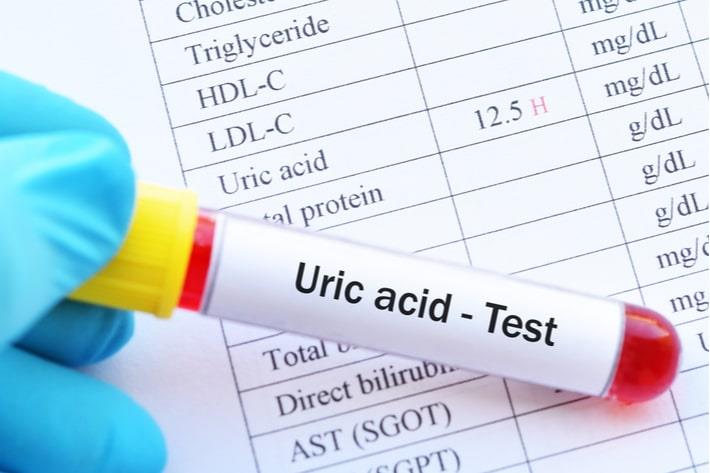מבחינה שעליה כתוב בדיקת חומצת שתן URIC ACID