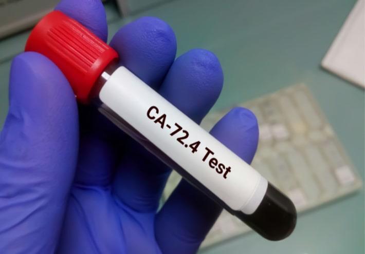 יד אוחזת במבחנה עם דם לצורך בדיקת סמן סרטני CA 72.4