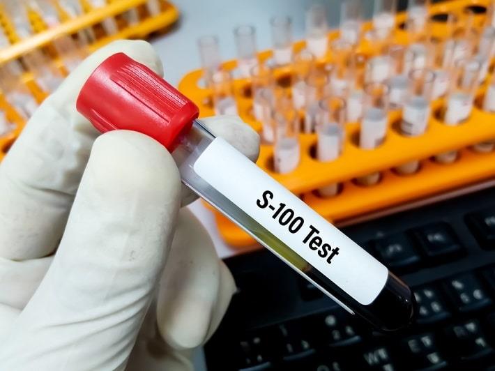 מבחנה עם דם של בדיקת חלבון S-100 בדם