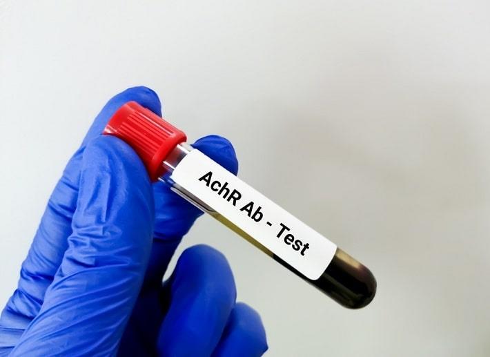 יד אוחדת במבחנה עם דם שעליה כתב בדיקת נוגדנים לקולטן אצטילכולין, ACHR.AB