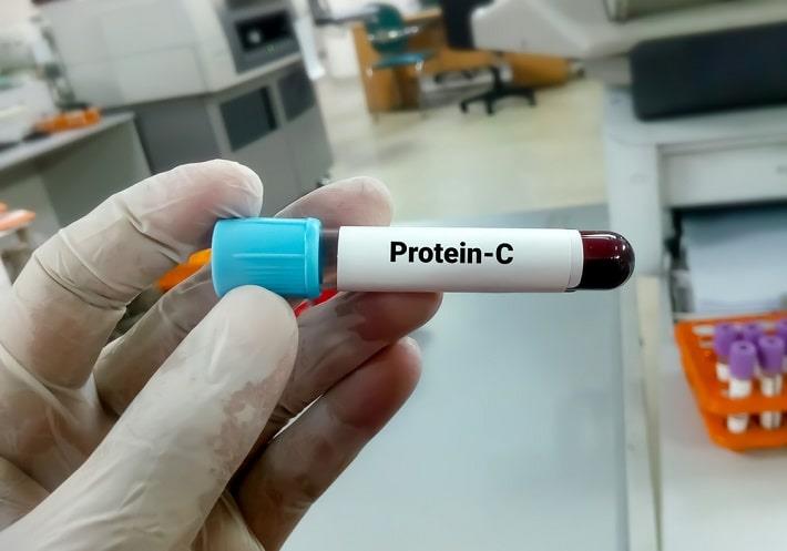 יד אוחזת במבחנת דם של בדיקת חלבון C