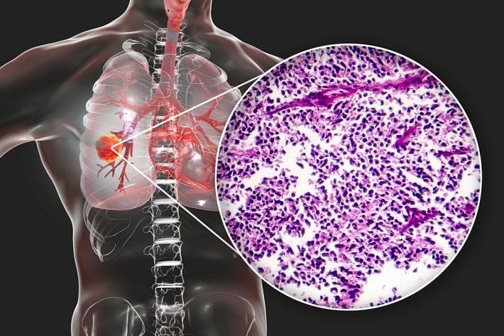 תקריב של תא סרטני של סרטן ריאות SCLC מתוך הדמיה של גוף אדם, בדיקת ANTI HU 