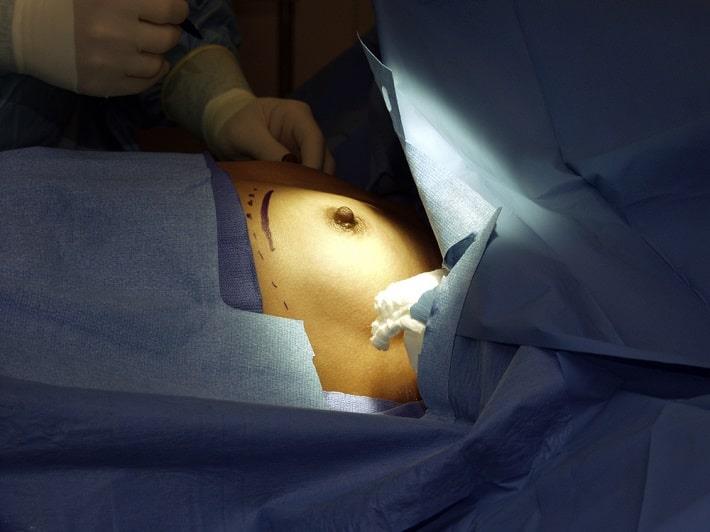 שד מואר ומסומן בחדר ניתוח לקראת ניתוח הגדלת חזה 