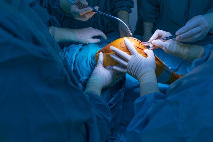 מנתחים בחדר ניתוח מסמנים את החתך בברך של מטופל לפני החלפת ברך
