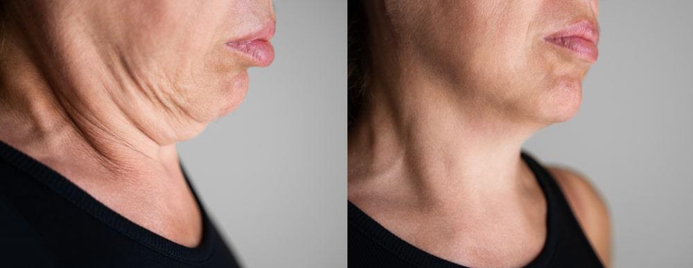 תמונה של אישה מבוגרת לפני ואחרי ניתוח מתיחת פנים, הרמת פנים