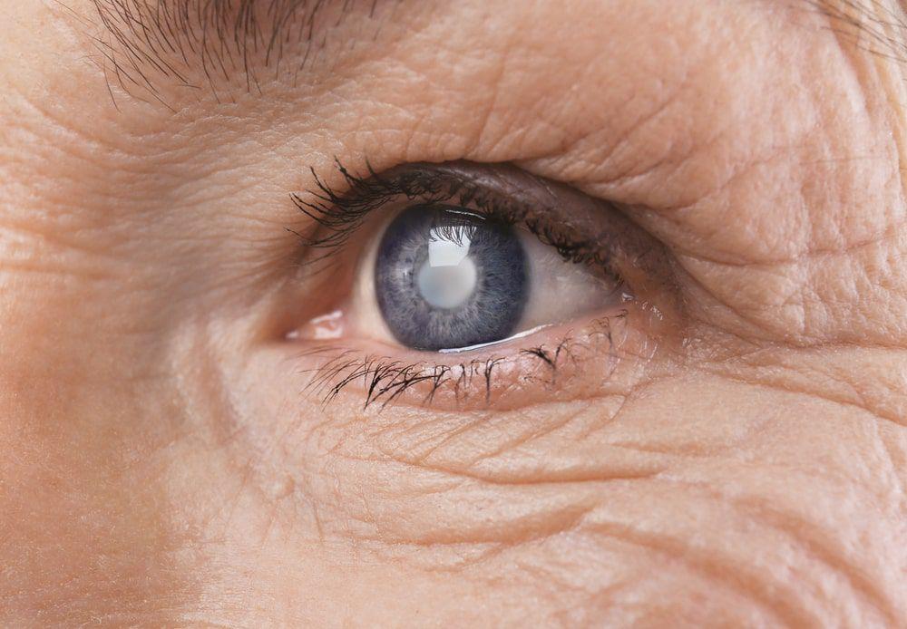 תקריב של עין עם הזקוקה לניתוח קטרקט