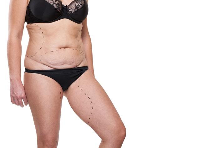 אישה לאחר הרזייה עם עודפי עור באזור הבטן, הסרת עודפי עור 
