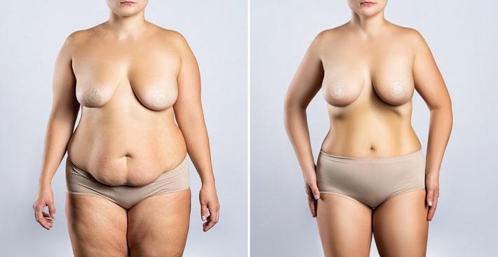 אישה בעירום לפני ואחרי ניתוח מתיחת ירכיים משולב עם מתיחת בטן