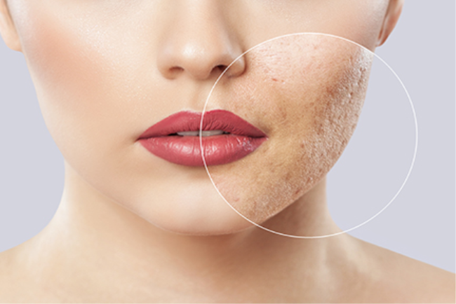 אישה סובלת מצלקות בגלל מחלת אקנה 