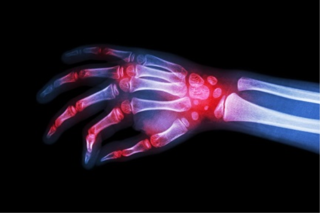 צילום רנטגן של מפרק כף יד עם דלקת, אבחון של מחלה ראומטולוגית