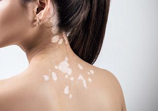 מחלות אוטואימוניות