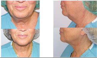 טיפול בסנטר כפול: גם ליופי וגם לבעיות נשימה בשינה