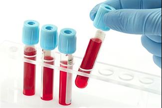 זן אלים במיוחד של HIV התגלה בקובה