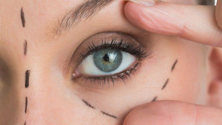 צניחת עפעפיים