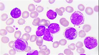 מדוע חלק מהטיפולים החדשים לסרטן הדם אינם נגישים לחולים?