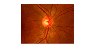 כאבי ראש, כאבי עיניים והשמנה: מה הקשר וכיצד מטפלים?