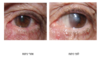 פטריגיום : מדוע הוא מתפתח וכיצד ניתן לטפל בו?