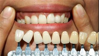 המדריך למטופל: הכל על השתלת שיניים