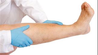 לימפאדמה בגפיים: הכירו את הניתוח שעשוי להעלים את הבצקות