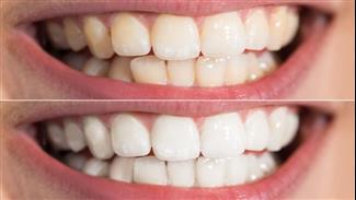 אסתטיקה דנטלית: 4 טיפולים שיסייעו בשיפור מראה השיניים