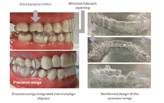 אסתטי, מהיר ונוח: טיפול אורתודנטי באמצעות קשתיות שקופות