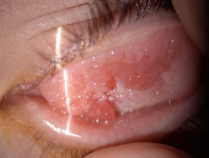 גושי רקמה קטנים מתחת לעפעף העליון המתפתחים במצבים של דלקת אביבית ורנליס