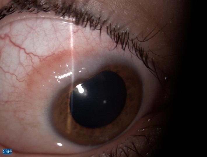 עדשת עין עכורה בעקבות מחלת הורנליס