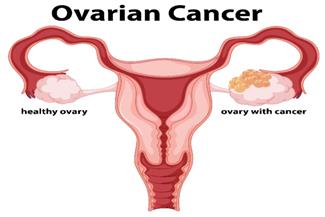 מחזור לא סדיר: האם הוא יכול להעיד על סרטן השחלות?