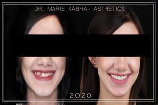 שיקום הפה האסתטי שהשיב את היכולת לחייך בביטחון