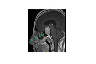 גידולי היפופיזה (בלוטת יותרת המוח): האם תמיד צריך לטפל?