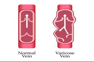 אי ספיקה ורידית : מה גורם להתפתחות המחלה ואיך ניתן לטפל בה?