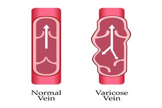 אי ספיקה ורידית : מה גורם להתפתחות המחלה ואיך ניתן לטפל בה?